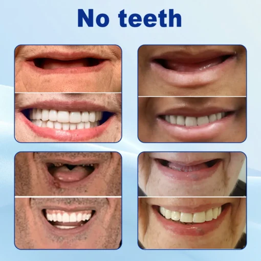 Nurbini™ Advanced Customized Full Denture Set