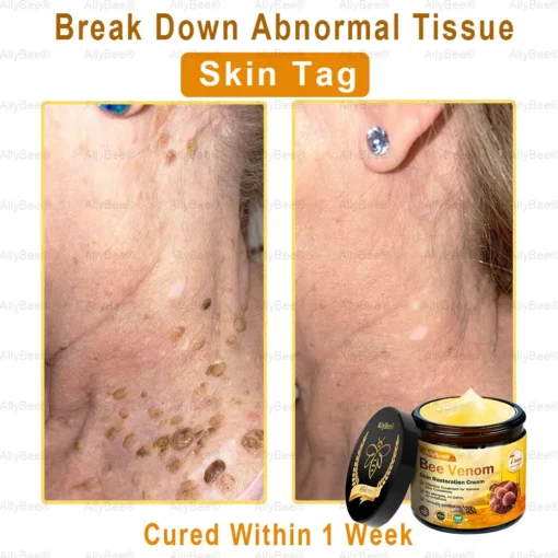 AllyBee® Skin Treatment Cream