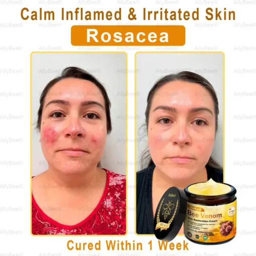 AllyBee® Skin Treatment Cream