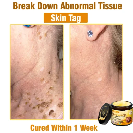 AllyBee® Advanced Skin Treatment Cream
