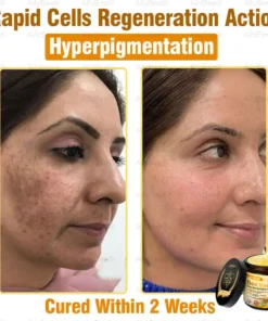 AllyBee® Advanced Skin Treatment Cream