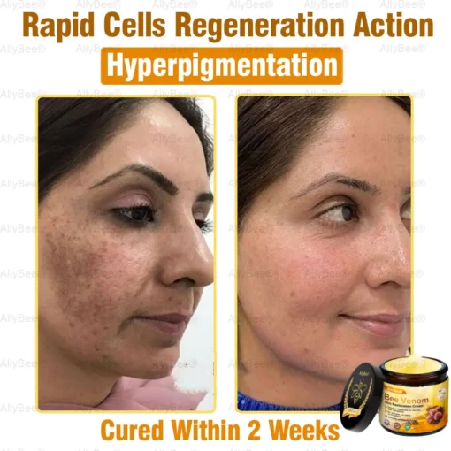 AllyBee® Advanced Skin Treatment Cream