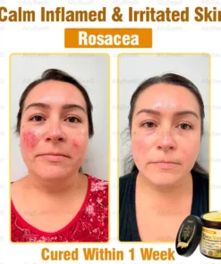 AllyBee® Advanced Skin Treatment Cream