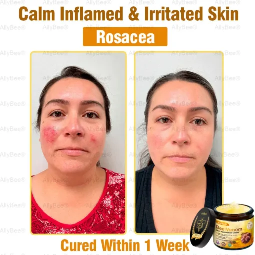 AllyBee® Advanced Skin Treatment Cream
