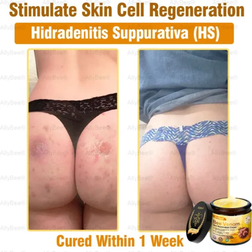 AllyBee® Advanced Skin Treatment Cream